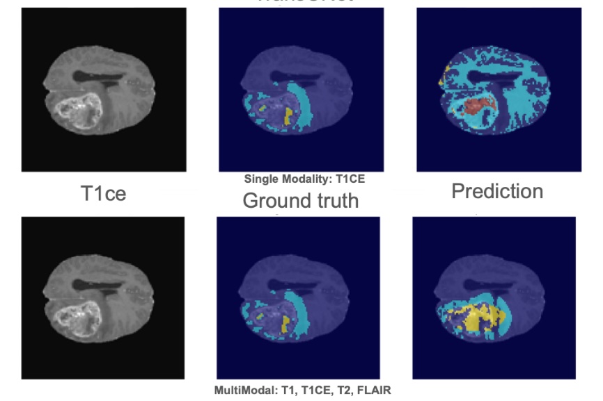Brain Tumor Segmentation using Convolutional Nerual Networks and Vision Transformers